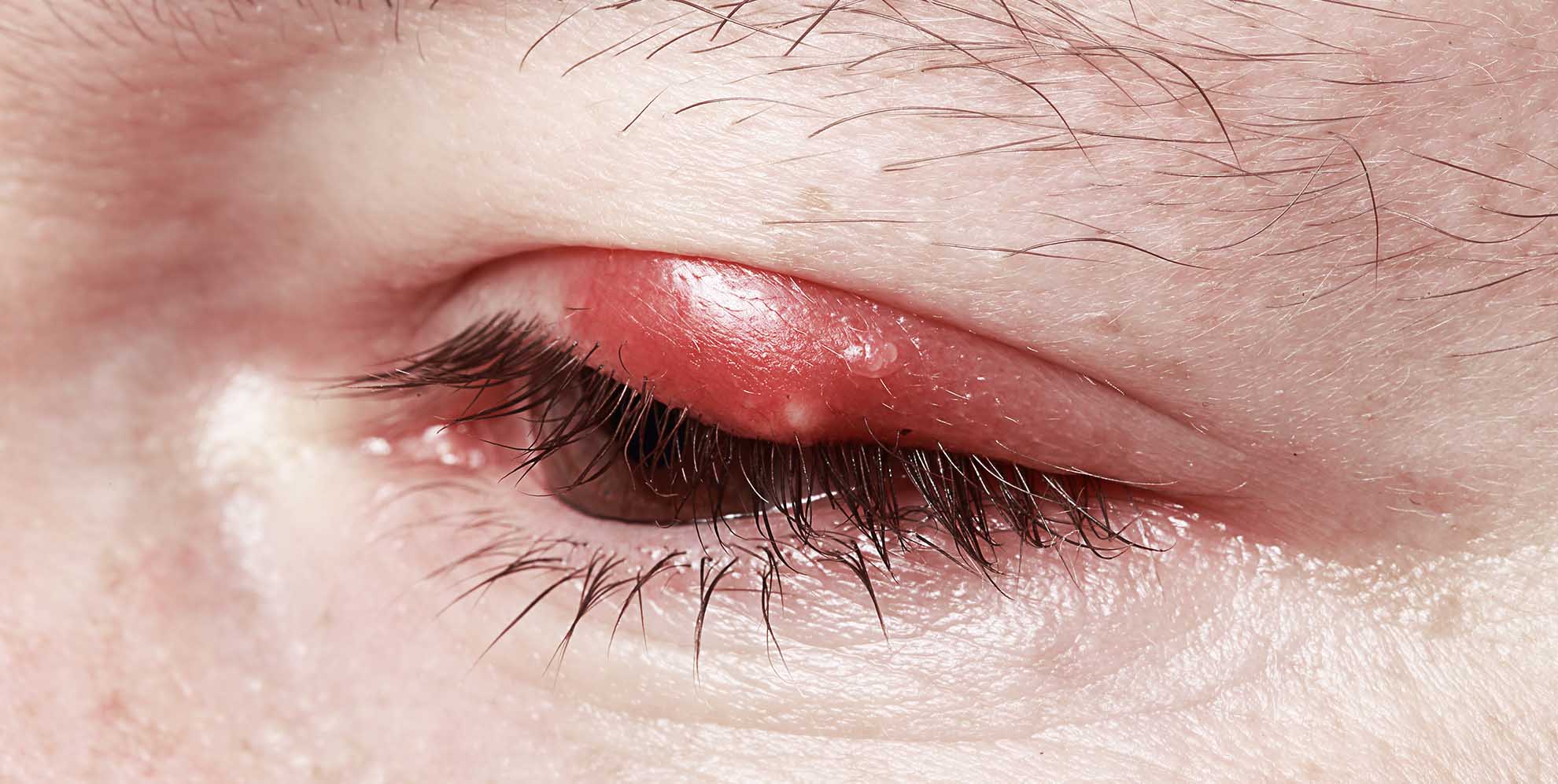 Abszess: Symptome, Ursachen, Diagnose und Behandlung - Was Sie wissen ...